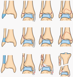Figure 2. Common ankle fracture patterns arranged by the level of the fibula fracture. The top row shows type A (Weber A) injuries below the syndesmosis, the middle row shows type B (Weber B) injuries at the level of the syndesmosis, and the bottom row shows type C (Weber C) injuries above the syndesmosis, including a high fibula (Maisonneuve) fracture. Within each row, the pattern progresses from an isolated fibula fracture to injuries that also involve the medial malleolus and the posterior malleolus. 
