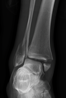 Figure 3. Mortise view x-ray of the ankle demonstrating a fracture of the distal fibula (lateral malleolus) and medial malleolus. The mortise view is taken with the foot rotated slightly inward and allows the joint space around the talus to be assessed on all sides.