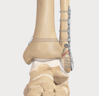 Figure 4. Fixation of a lateral malleolus (fibula) fracture with a plate and screws. In this illustration a flexible suture-button device has also been passed across the syndesmosis to hold the tibia and fibula in their normal relationship while the ligaments heal. (credit: Arthrex.com)