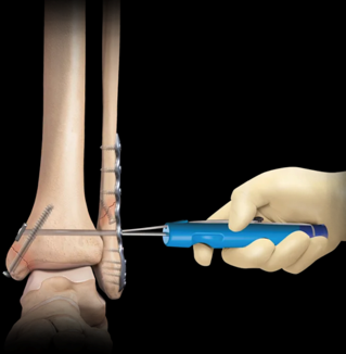 Figure 5. Fixation of a bimalleolar ankle fracture. The fibula has been stabilized with a plate and screws on the outside of the ankle, and a screw is being placed across the medial malleolus on the inside. (credit: Arthrex.com)