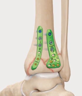 Figure 6. Fixation of a posterior malleolus fracture. Small plates placed at the back of the tibia are used to reduce and buttress the posterior fragment, an approach that has been associated with better patient-rated outcomes than leaving the fragment untreated. (credit: Arthrex.com)