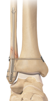 Figure 7. Intramedullary nail fixation of a distal fibula fracture. The nail is inserted down the center of the fibula through a small incision at the tip of the bone and locked in place with screws. This technique requires less soft tissue dissection than a plate and has been associated with a lower infection rate. (credit: Arthrex.com)