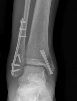 Figure 8. X-ray of an ankle after surgical fixation. A plate and screws hold the fibula on the outside of the ankle, and a screw holds the medial malleolus on the inside. The talus is centered under the tibia, indicating that the mortise has been restored.