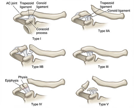 the bones of the upper extremity with the clavicle labeled