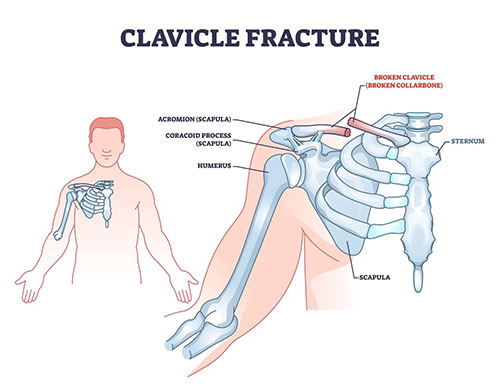 the bones of the upper extremity with the clavicle labeled