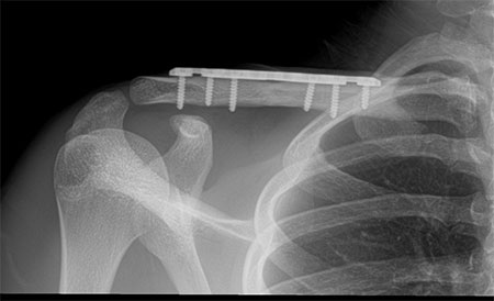the bones of the upper extremity with the clavicle labeled