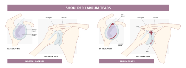 Figure 4. Normal shoulder labrum