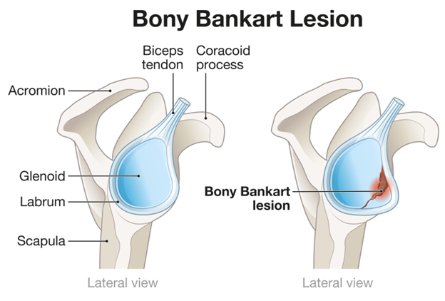 Figure 5. Example of a Bony Bankart glenoid fracture