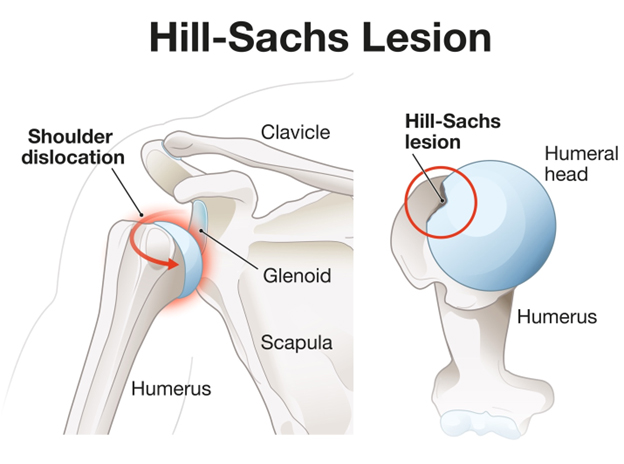 Figure 6. Anterior shoulder dislocation