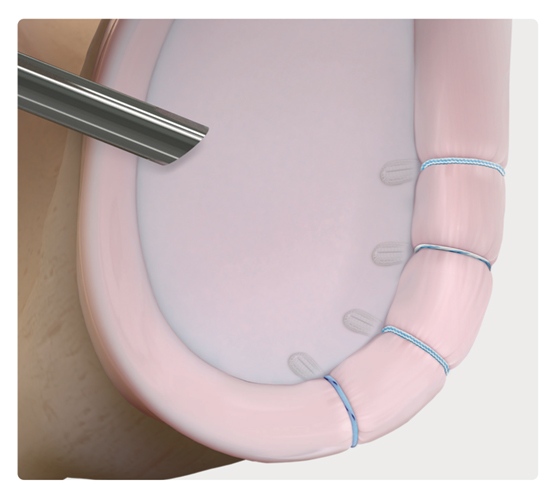 Figure 7. Example of a Bankart repair