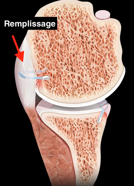 Figure 8. Example of a Remplissage performed