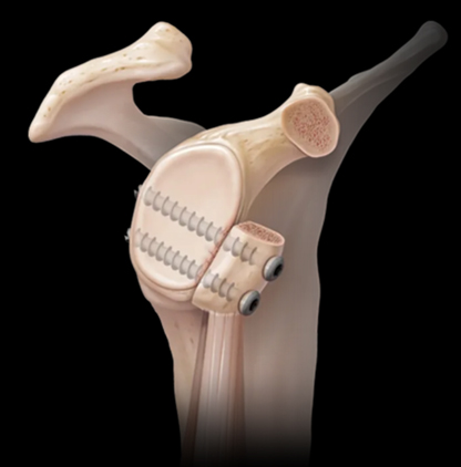 Figure 9. Visualization of a Latarjet procedure