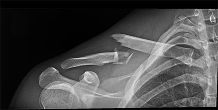 the bones of the upper extremity with the clavicle labeled