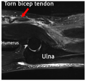 MRI Img