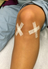 Steri strips
