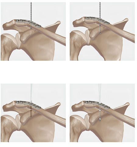the bones of the upper extremity with the clavicle labeled