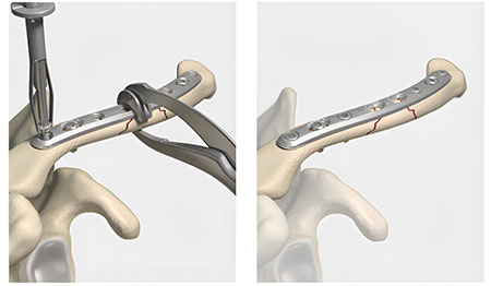 the bones of the upper extremity with the clavicle labeled