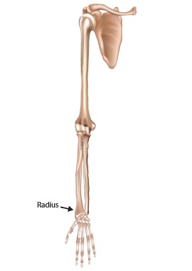 Wrist Fracture