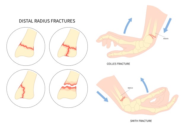 Wrist Fracture