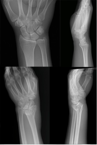 Wrist Fracture