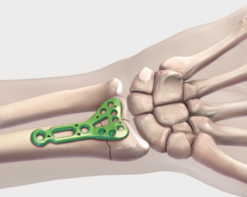 Wrist Fracture