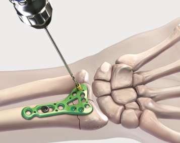 Wrist Fracture