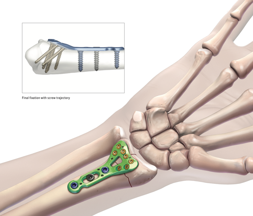Wrist Fracture